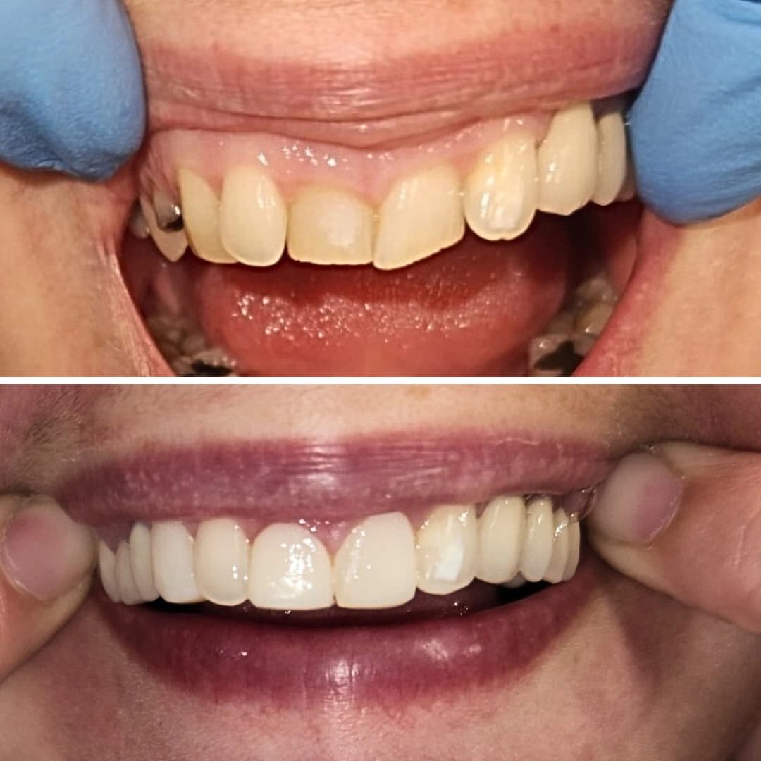 Before And After 2